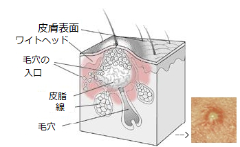 ニキビ(Acne)Ⅰ