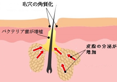 ニキビ(Acne)Ⅱ